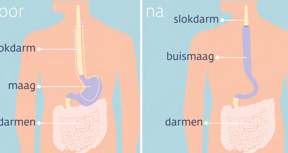 Afbeelding voor Nesidioblastose na buismaagoperatie