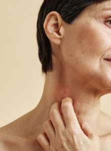Afbeelding voor Nieuwe richtlijnmodules huidaandoeningen: psoriasis en constitutioneel eczeem